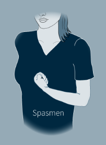 Illustration einer spastischen Hand
